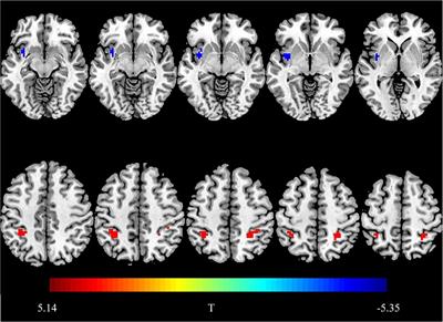 Regional Neural Activity Abnormalities and Whole-Brain Functional Connectivity Reorganization in Bulimia Nervosa: Evidence From Resting-State fMRI